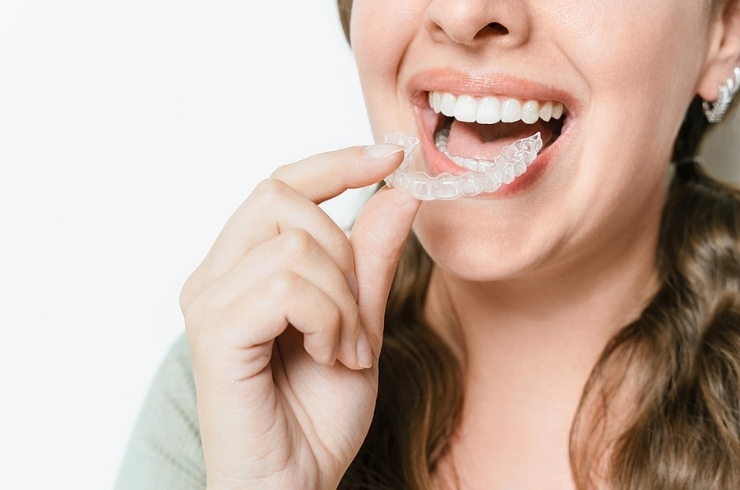 Tooth Aligners, Ramesh Dental Care, Dr. Ramesh Garikapati