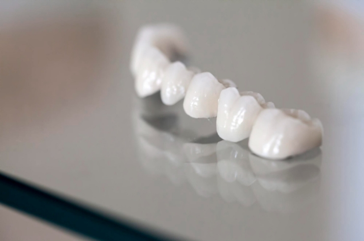 Zirconia Crowns, Ramesh Dental Care, Dr. Ramesh Garikapati