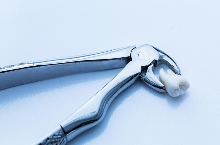 Wisdom Tooth Extraction